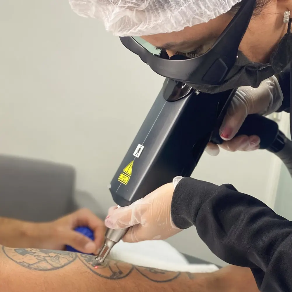 Nadia Neiva realizando remoção de tatuagem a laser