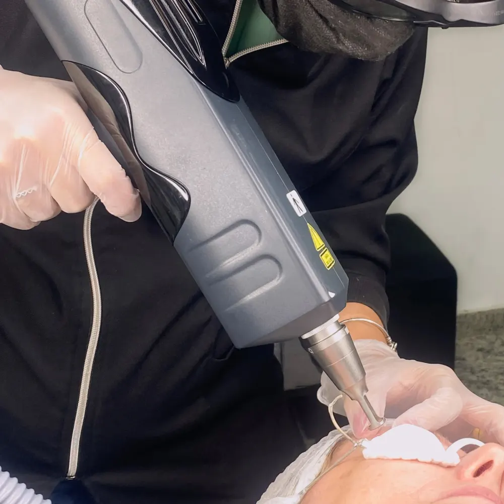 Remoção a laser de micropigmentação de sobrancelha