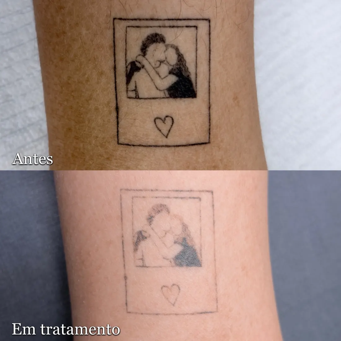 Tatuagem de polaroid no braço antes e depois da remoção a laser