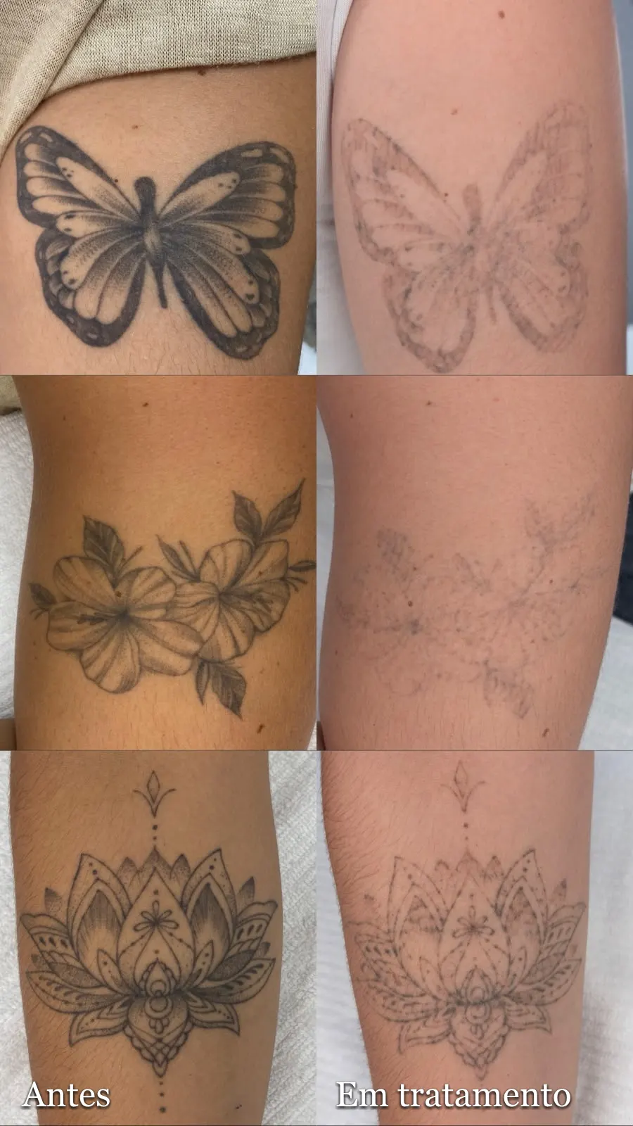 Tatuagens de borboleta, flores e flor de lótus antes e depois da remoção a laser
