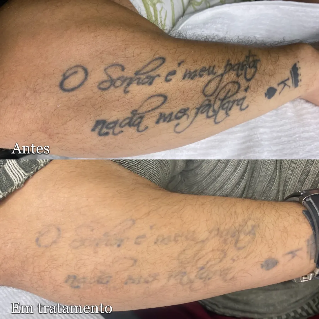 Tatuagem escrita no antebraço antes e depois do clareamento a laser