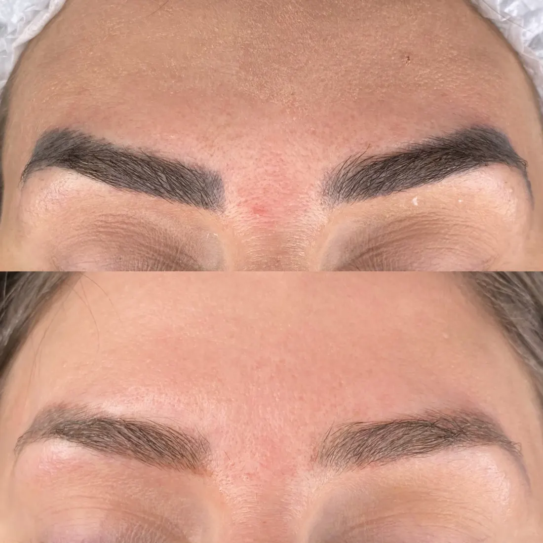 Micropigmentação de sobrancelha antes e depois da remoção a laser